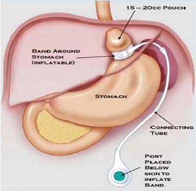 Gastric band procedure - Band around stomach (inflatable), 15-20cc pouch, stomach, connecting tube, port placed below skin to inflate band