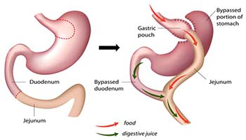 gastric bypass procedure - left: duodenum, jejunum; right: gastric pouch, bypassed portion of stomach, jejunum, bypassed duodenum